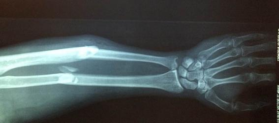 Demuestran la utilidad de la técnica Trabecular Bone Score para identificar la fragilidad ósea en pacientes con hiperparatiroidismo primario