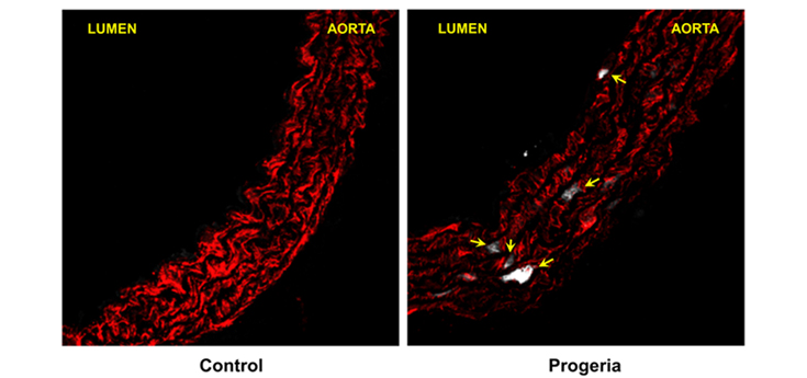 Descubren una nueva diana terapéutica para frenar la aterosclerosis precoz en progeria