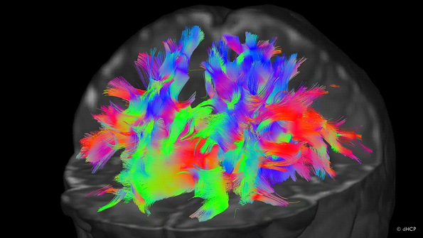 La resonancia magnética puede ayudar a predecir la evolución cognitiva de los bebés prematuros