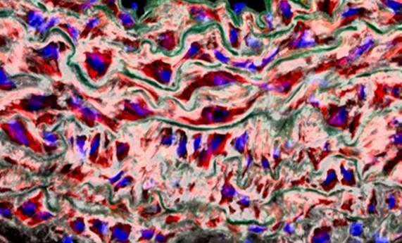 Descubren una nueva causa de los aneurismas de aorta y una posible vía para prevenirlos sin cirugía Descubren una nueva causa de los aneurismas de aorta y una posible vía para prevenirlos sin cirugía