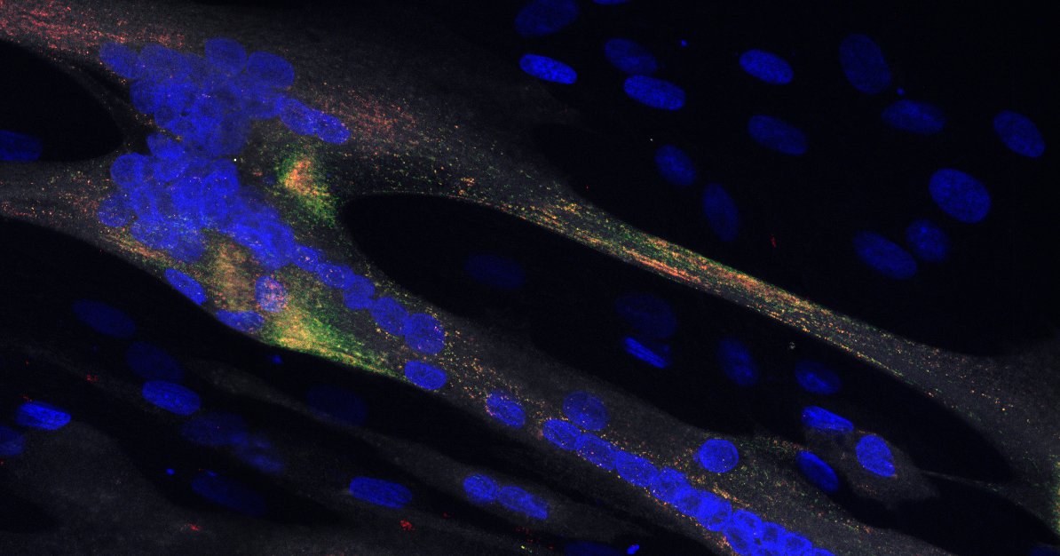 Descubren un nuevo gen causante de una miopatía congénita