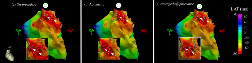 Desarrollan una nueva técnica de procesado de señal para intervenciones de ablación con catéter